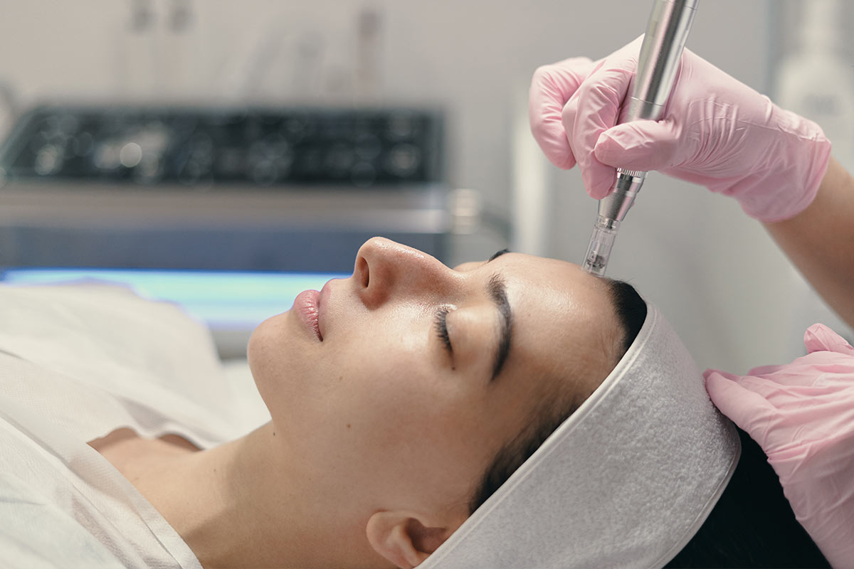 Mikro-Needling im Gesicht bei My Beauty & Health in Frankfurt-Bockenheim