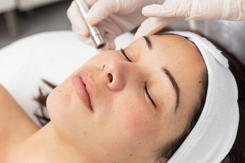 Person lying with eyes closed during a facial treatment, a handheld device being applied near the forehead by a gloved practitioner